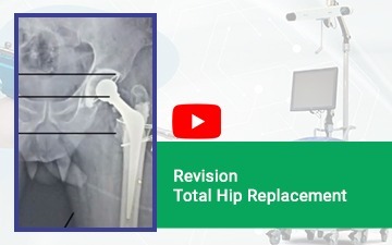 Revision Total Hip Replacement